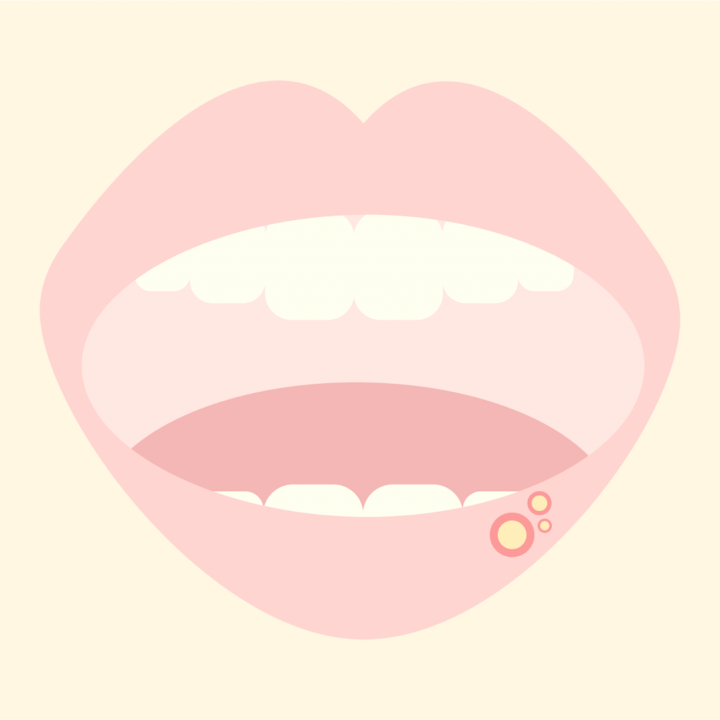 Chemotherapy how to prevent and relieve mouth ulcers and mucositis